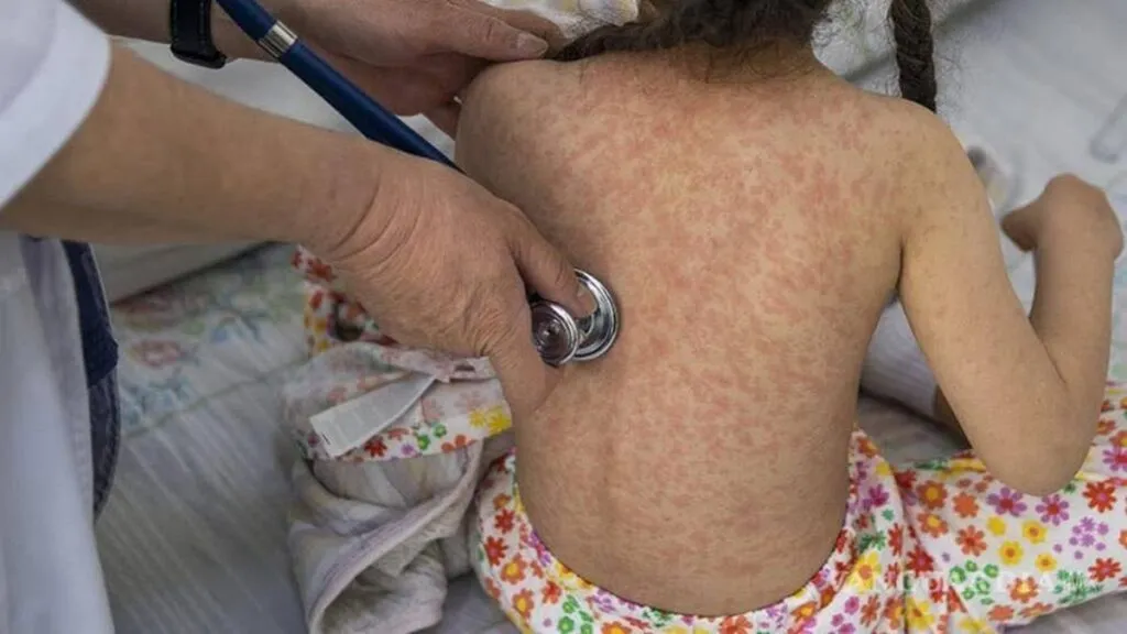 Sarampión está de regreso por negligencia de los gobiernos de MORENA: PRI