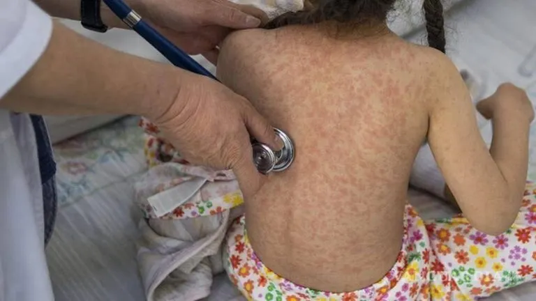 Sarampión está de regreso por negligencia de los gobiernos de MORENA: PRI